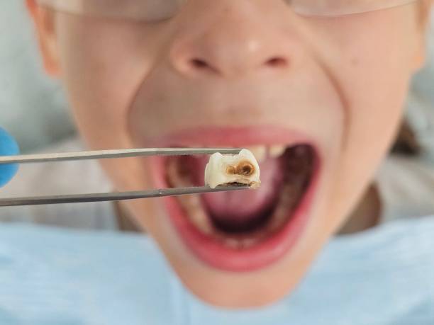 Best Emergency Broken Tooth Repair in Palestine, IL